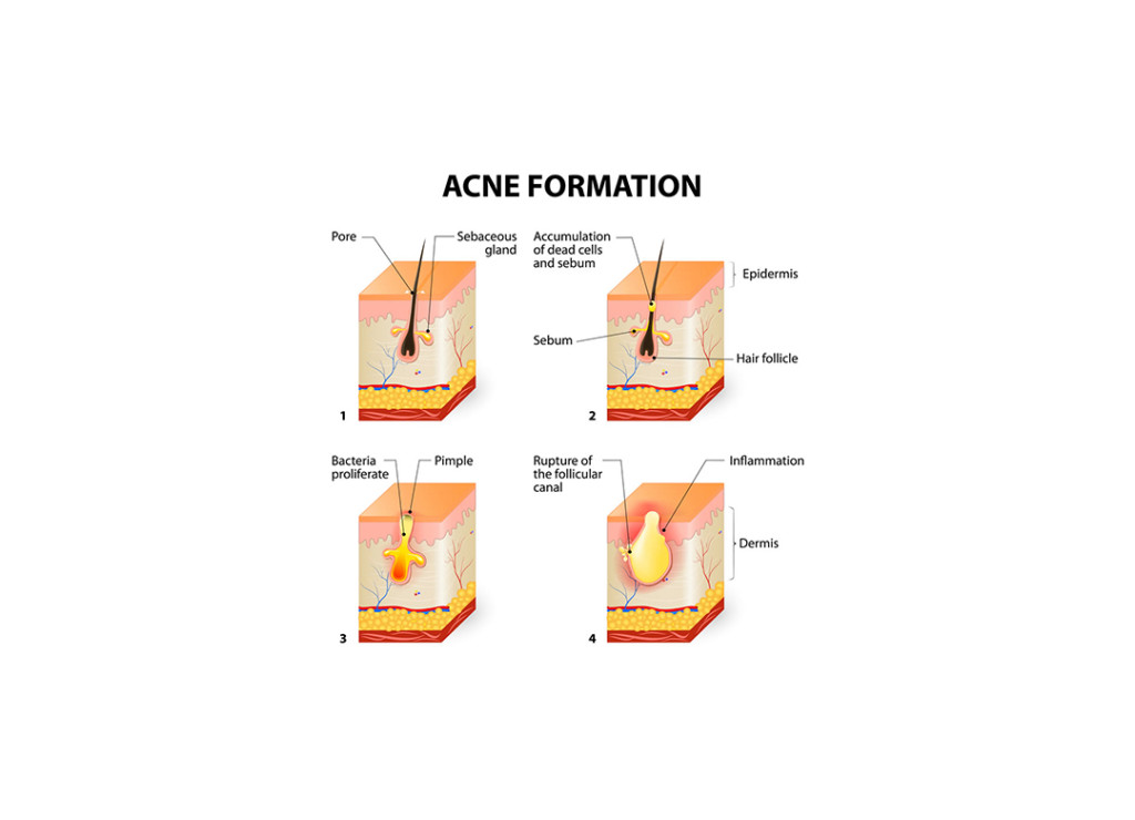 Fierybread - Mun an, acne, pimple, mun dau den, mun boc, tri mun