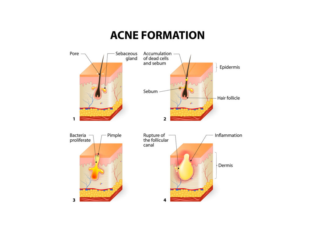 post_0091_image__0004_acne-formation