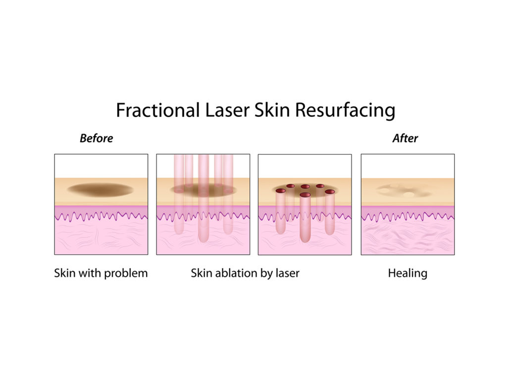 Fierybread Thuy Vo Acne Scar Cause and Treatment Nguyên nhân giải pháp điều trị sẹo mụn