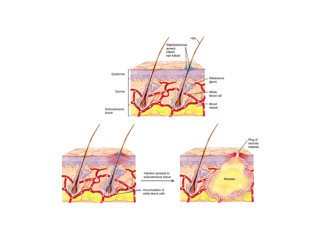 Post_0101_Image__0006_folliculitis-18