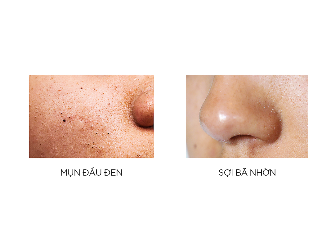 Mụn đầu trắng nhỏ li ti là gì? 3 bước xử lý sợi bã nhờn hiệu quả